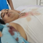 समझाइश देना पड़ा महंगा: डॉक्टर पर प्रेमी जोड़े का हमला, सिर पर मारा पत्थर
