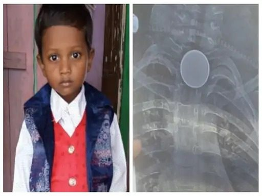 Death by swallowing a coin