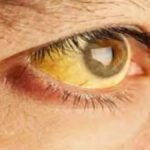 CG NEWS : विवि के कन्या छात्रावास में फूटा पीलिया का बम, 12 छात्राएं बीमार; 2 की हालत गंभीर, एम्स में भर्ती