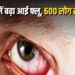 CG Eye Flu : आई फ्लू का कहर, एक महीने में 600 से ज्यादा संक्रमित; स्वास्थ्य विभाग ने जारी की एडवाइजरी